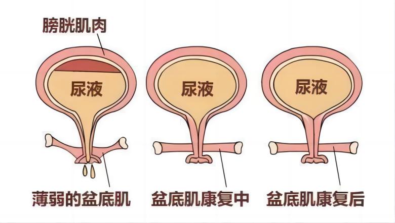 J9直营医疗丨如何有效运用振动提高盆底肌肉激活水平？